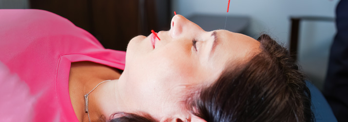 Chiropractic Burke VA Acupuncture Treatment